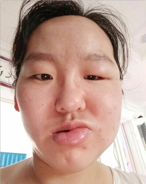 用蜂刺疗法治疗第二天