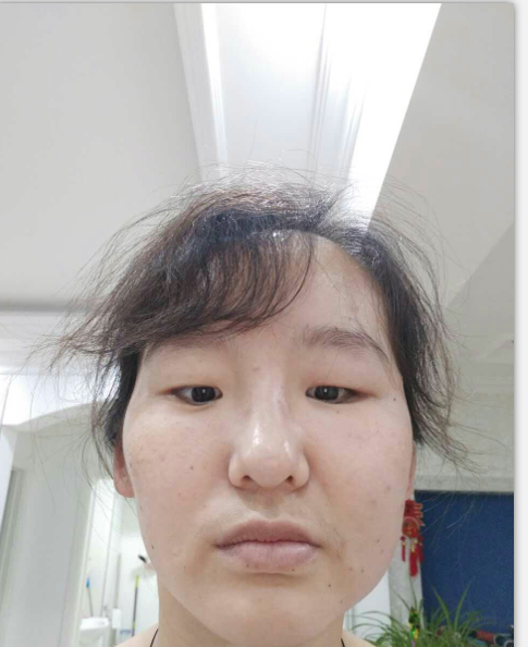 用蜂刺疗法治疗第4天