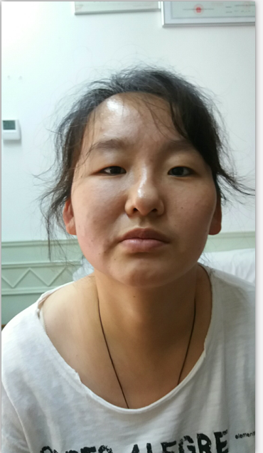 用蜂刺疗法治疗第三天