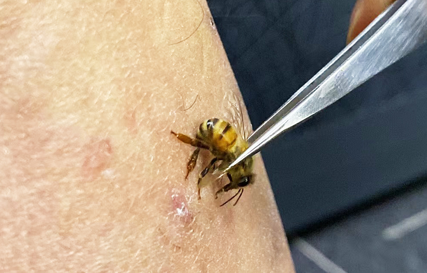 蜂针疗法是一种天然的绿色疗法