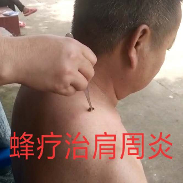 蜂疗治肩周炎
